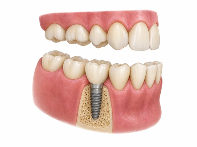 AI educational model showing one implant-supported crown beside neighbouring teeth and opposite teeth.