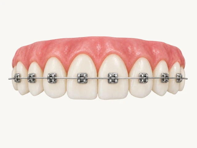 Educational illustration of metal brackets and an archwire on the outer tooth surfaces