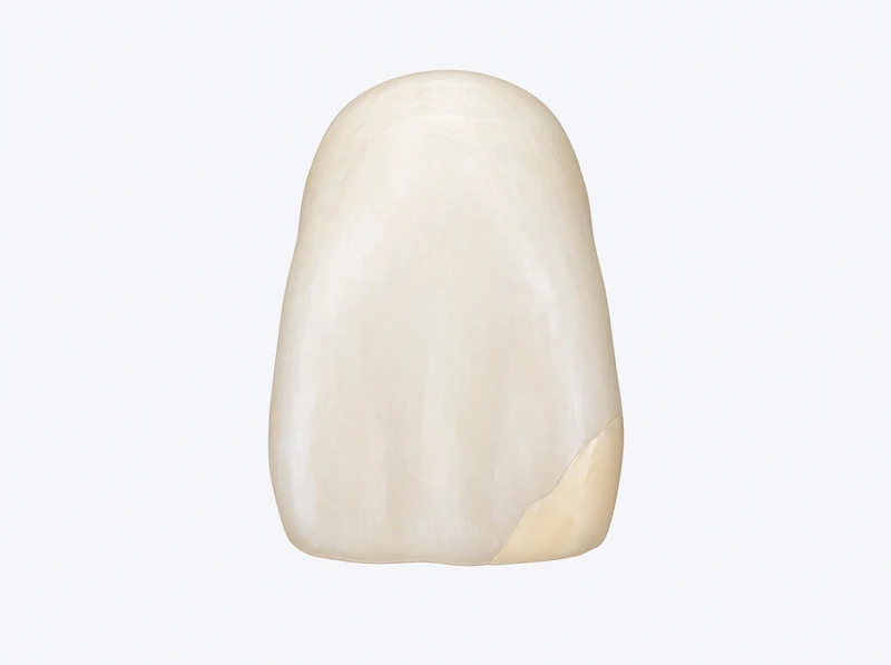 Educational model of a front-tooth crown with a small, directly connected composite region