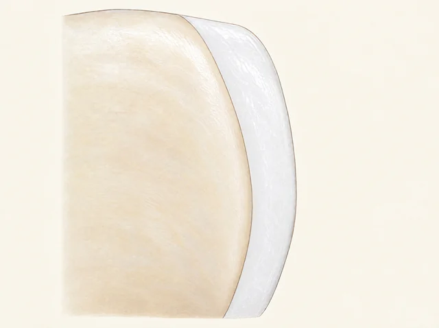 Enlarged schematic of a thinner remaining natural-tooth region and a bonded ceramic layer after limited facial preparation.