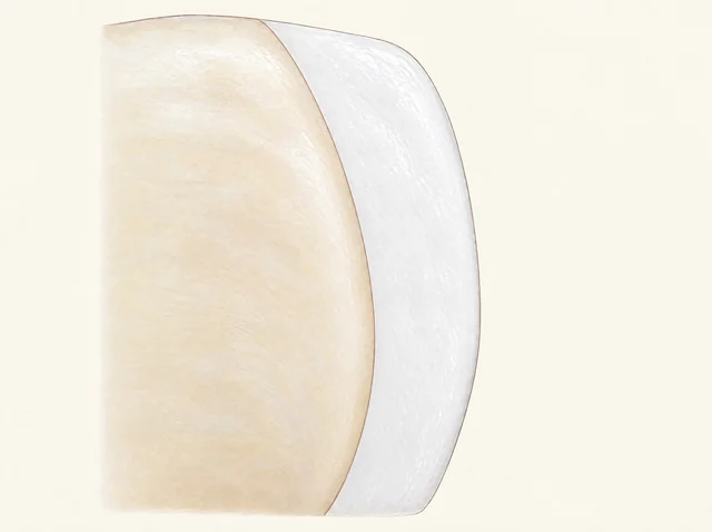 Enlarged schematic of a greater reduction of the natural-tooth region and a correspondingly thicker bonded ceramic layer.