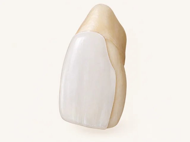 Educational model of a thin veneer on the front surface of a tooth.