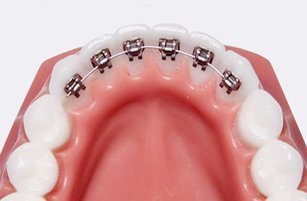 Close-up of brackets and an archwire fitted on the inner surface of upper teeth on a model
