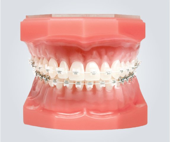 Dental training model fitted with tooth-coloured brackets and archwires on both arches