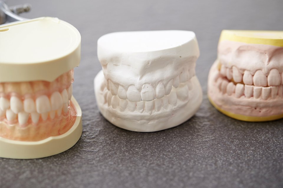 Three plaster study models of upper and lower dental arches on a work surface