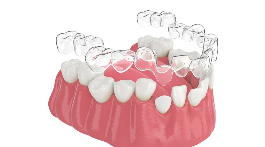 Render of a transparent aligner tray being seated over the lower arch