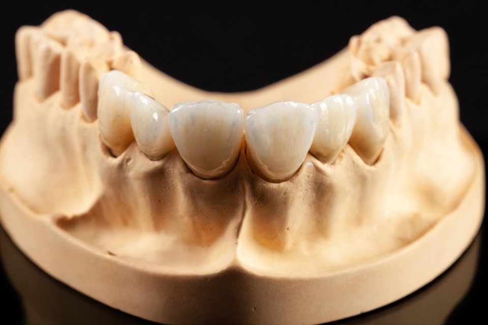 Finished ceramic front-tooth restorations seated on a plaster working model