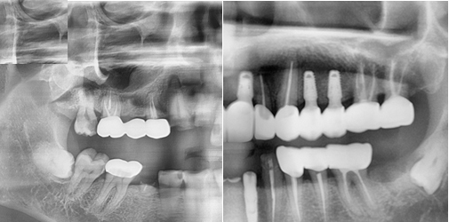 Implant X-ray case image 01