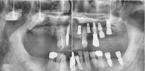 Implant X-ray case image 02