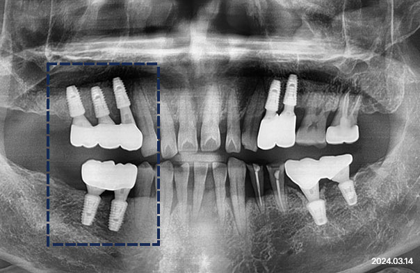Panoramic X-ray after implants placed with bone grafting to replace an existing bridge at Today Dental