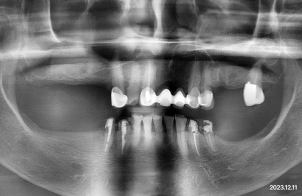 Panoramic X-ray recorded before molar implant placement with a sinus lift