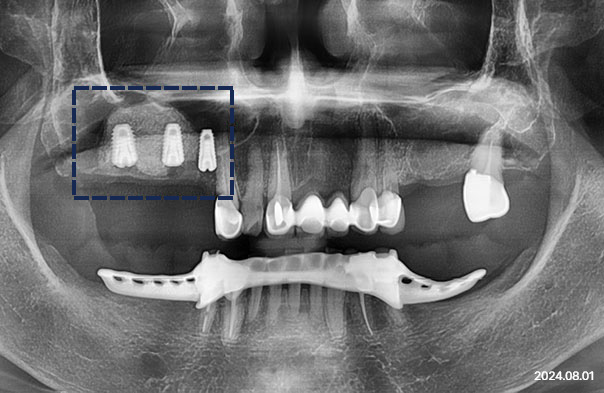 Panoramic X-ray after molar implant placement with maxillary sinus lift at Today Dental