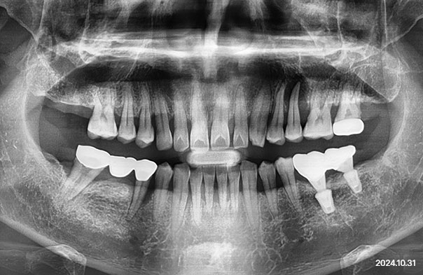 Panoramic X-ray recorded after molar implants placed with bone grafting, with the remaining teeth under review