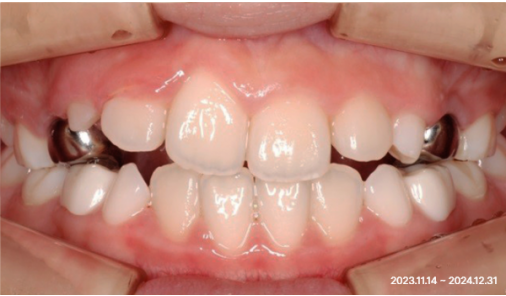Frontal intraoral photo of a child's teeth after growth-stage orthodontic treatment at Today Dental Bucheon clinic