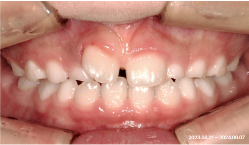 Frontal intraoral photo of a child's corrected front-teeth bite after orthodontic treatment at Today Dental Bucheon clinic