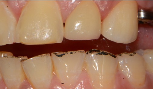 Front teeth after composite resin bonding repairing chipped and stained incisal edges
