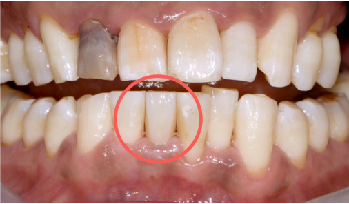 Lower front tooth rebuilt with tooth-coloured composite resin