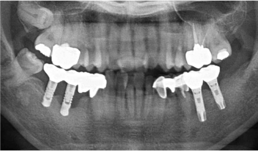 Today Dental 富川院區全口植牙治療後的環口 X 光片