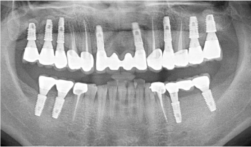 Today Dental 富川院區顯示全口植牙治療完成的環口 X 光片
