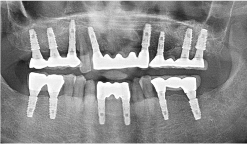 Today Dental 富川院區全口治療後上下顎植體假牙的環口 X 光片