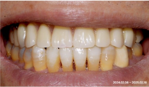 Implant-supported denture treatment record.
