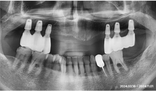 Panoramic X-ray recorded after implant denture treatment at the Bucheon clinic