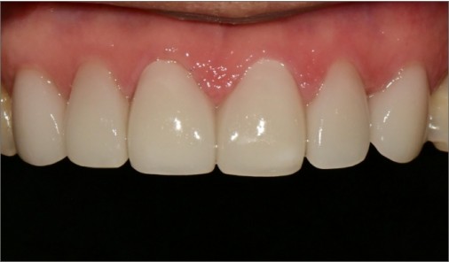 Intraoral photograph recorded after minimal-prep veneer treatment of the upper front teeth