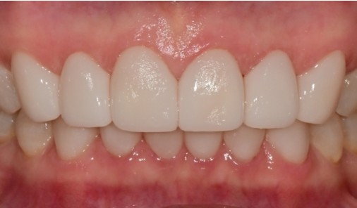 Intraoral photograph recorded after veneer treatment showing the upper front teeth