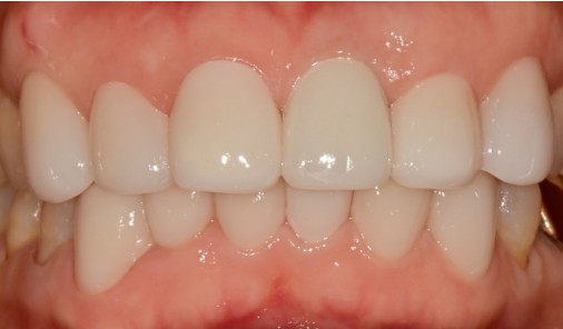 Intraoral photograph recorded after ceramic restoration of the upper front teeth