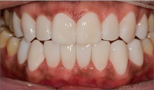 Intraoral photograph recorded after ceramic restoration showing the smile line