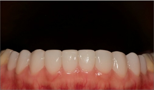 Minimal-prep veneer treatment record.