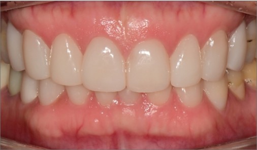 Minimal-prep veneer treatment record.