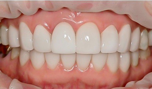 Frontal intraoral view of the upper and lower front teeth and gums.