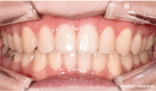 Intraoral photograph at the end of the recorded treatment period showing an aligned arch