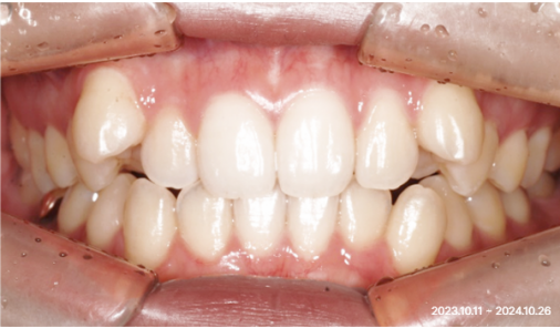 Intraoral photograph at the start of orthodontic treatment showing crowding and a high canine