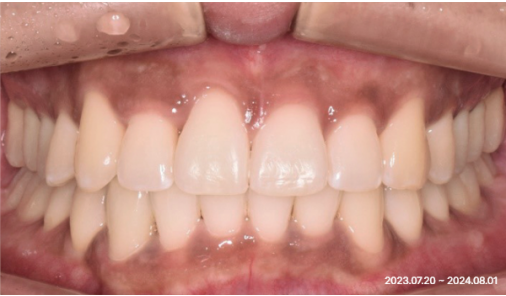 Intraoral photograph at the end of the recorded treatment period showing an even bite