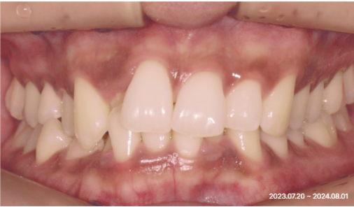 Intraoral photograph at the start of orthodontic treatment showing protruding upper front teeth