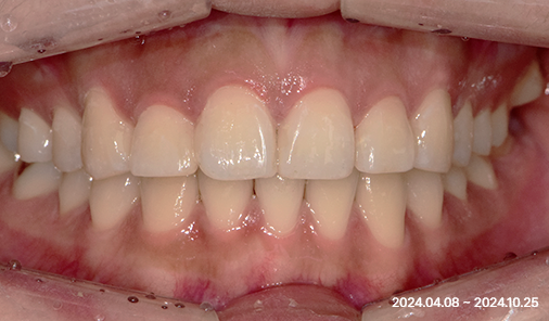 Before After orthodontic case 01