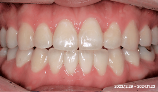 Before After orthodontic case 02