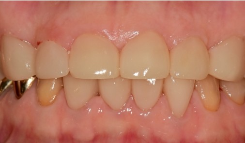 Intraoral photograph recorded after an old front-tooth restoration was replaced