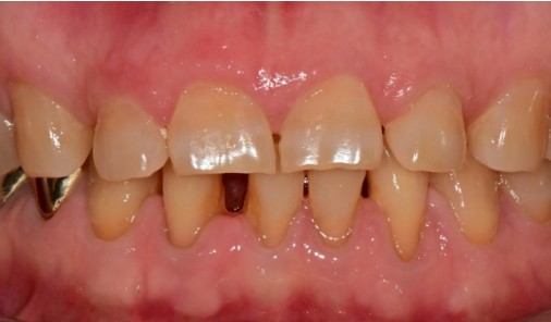 Intraoral photograph before restoration showing an old restoration and worn tooth edges