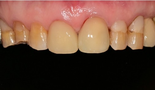 Intraoral photograph recorded after restoration of worn upper front teeth