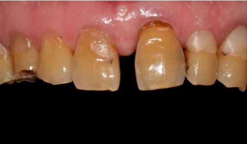 Intraoral photograph before restoration showing worn and discoloured upper front teeth