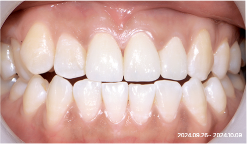 Intraoral photograph after front-tooth restoration showing a level edge line