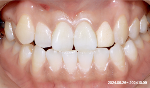Intraoral photograph before front-tooth restoration showing uneven upper front teeth