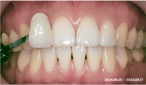 Intraoral photograph after treatment with the shade tab held next to the restored front teeth