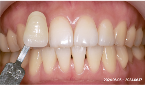 Intraoral photograph before treatment with a shade tab held next to discoloured front teeth