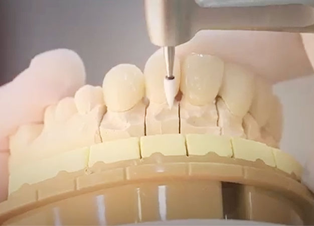 Dental technician shaping a ceramic front-tooth restoration on a plaster model